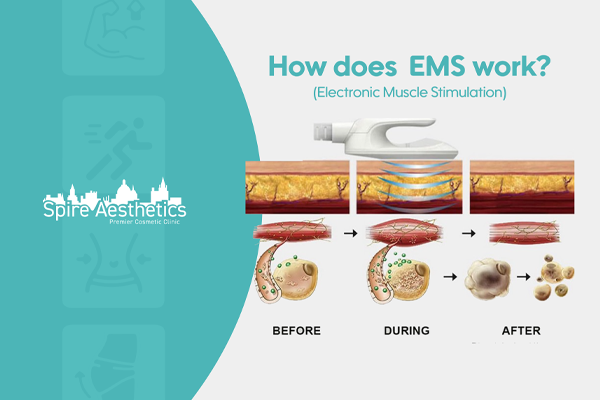 EMS treatment for post pregnancy weight loss treatment Hertfordshire
