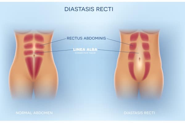 What Non-Surgical Options Are Available for Diastasis Recti Hertfordshire?