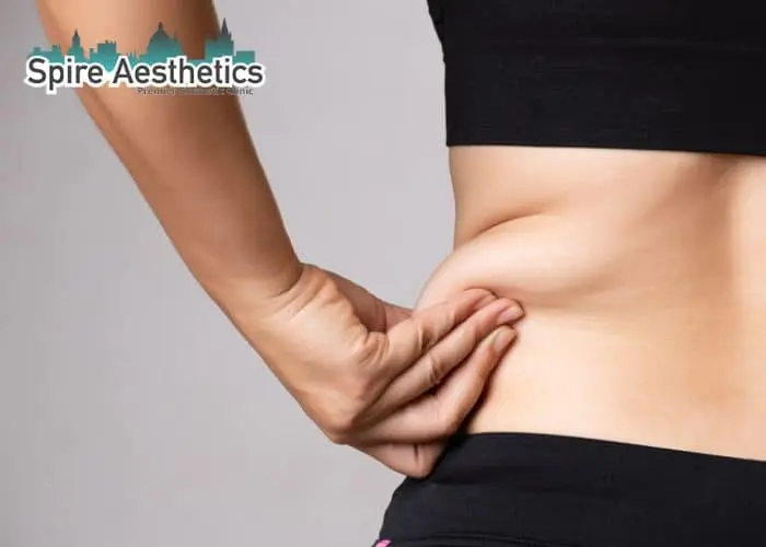 Image of woman pinching fat on their hips Hertfordshire. Fat Freezing treatment