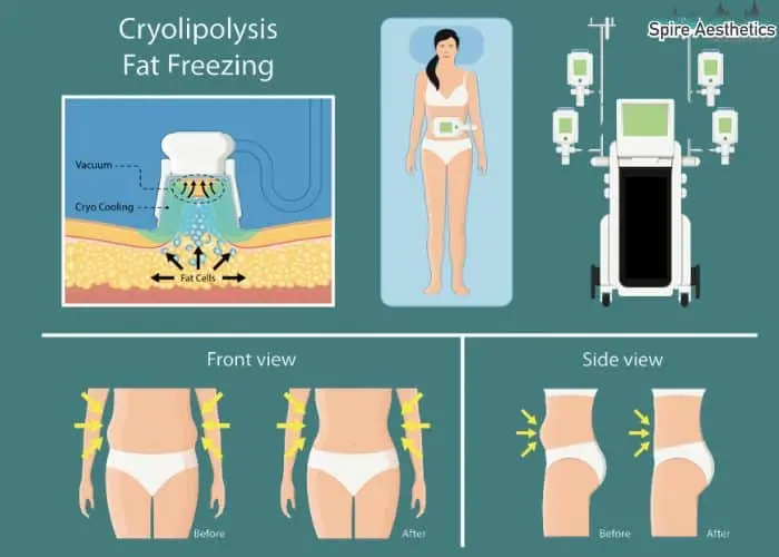 Fat freezing treatment Hertfordshire benefits for competitions to remove stubborn fat deposits.