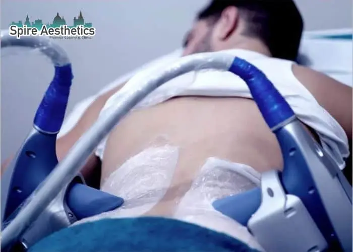 Man having fat freezing treatment done on love handles before a competitions Hertfordshire to create a sculpted look.