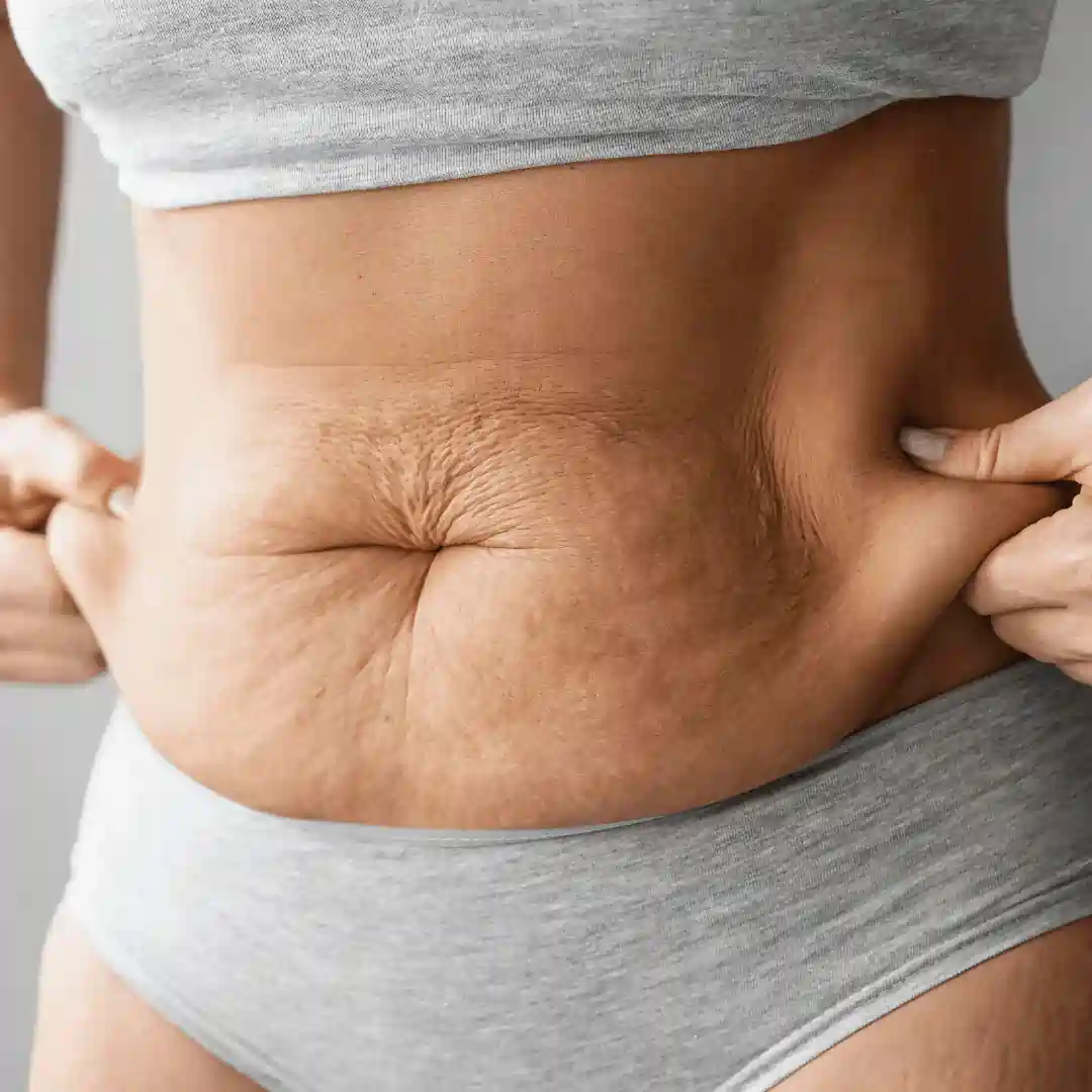 Is It Normal to Have Loose Skin After Pregnancy Hertfordshire?