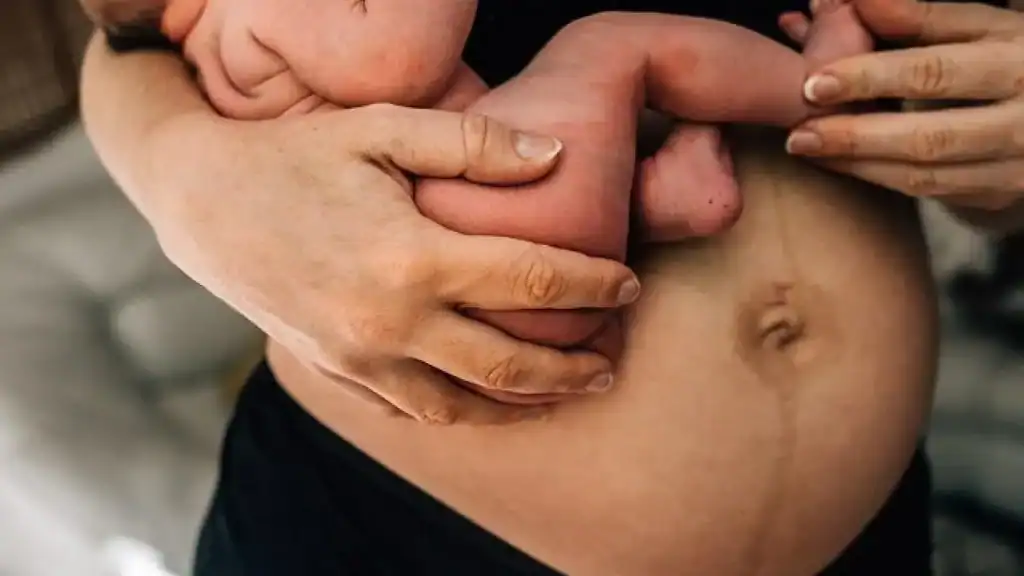 Why Is My Stomach Still Big After Pregnancy Hertfordshire?