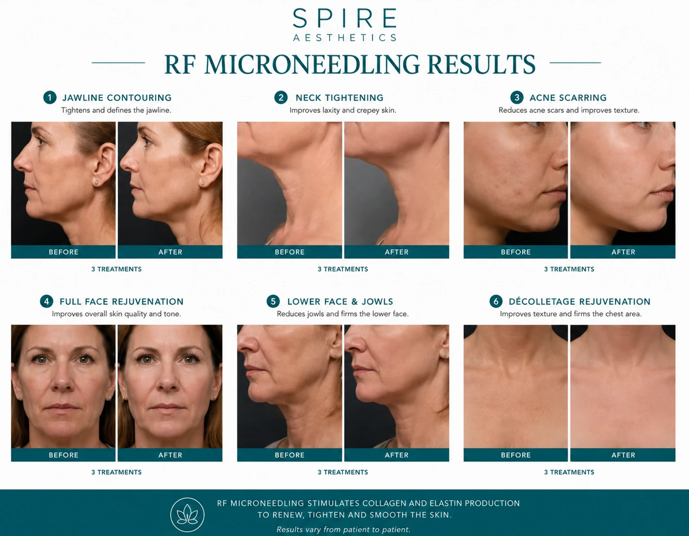 RF Microneedling Skin tightening Hertfordshire results