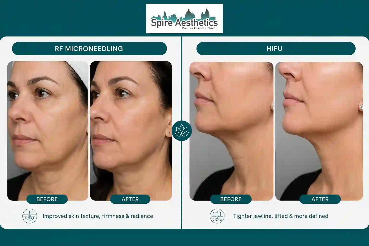 Can RF Microneedling and HIFU Be Combined Hertfordshire?