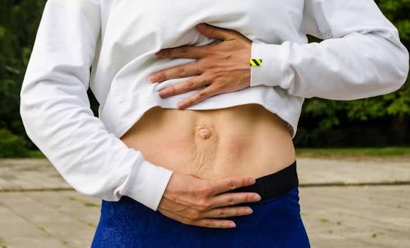 When Could Diastasis Recti Be the Missing Piece of the Puzzle Hertfordshire?