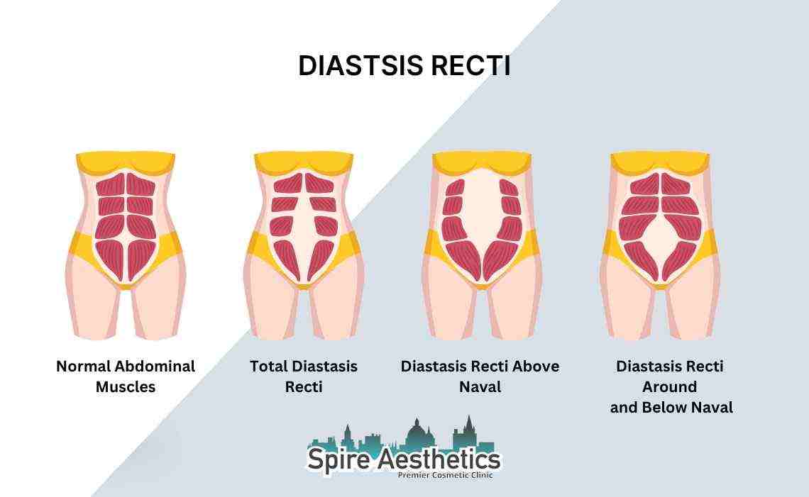 Is Non-Surgical Diastasis Recti Treatment Right for You? Common Concerns Answered Hertfordshire